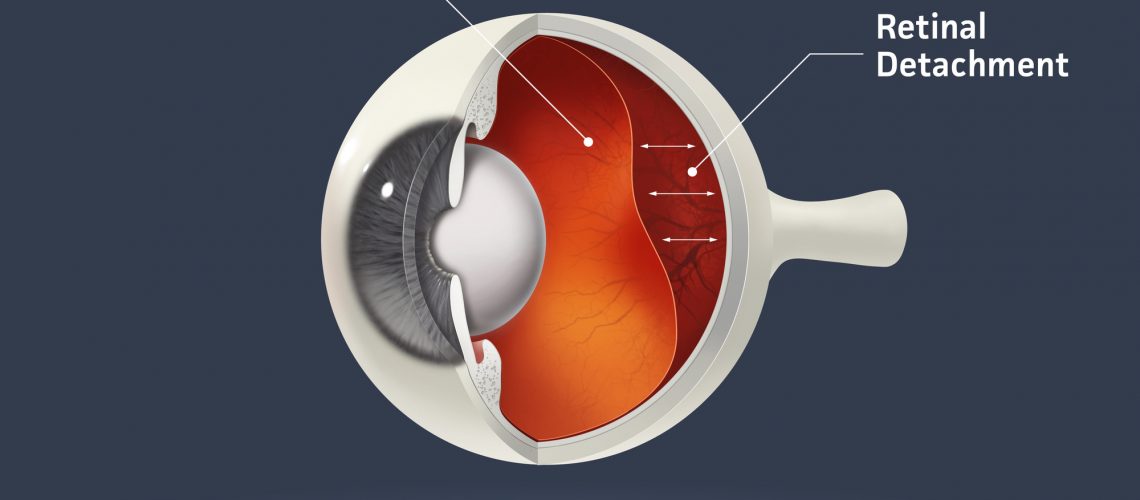 High quality raster illustration of retinal detachment with clipping path.