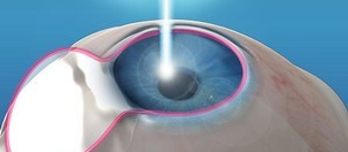 laser-refractive-surgery